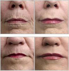 Micro Needling Before and After Photos - Lips