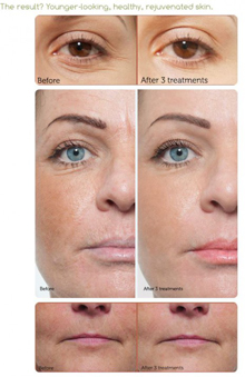 Micro Needling Before and After Photos - Eyes and Lips