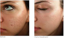 Micro Needling Before and After Photos - Acne Scara