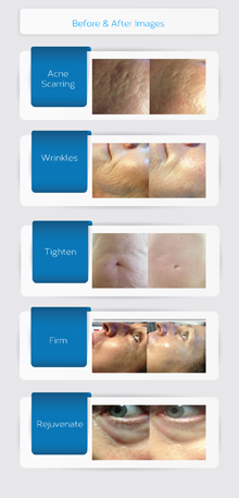 Micro Needling Before and After Photos